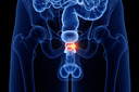 Darolutamida melhora a sobrevida global no câncer de próstata metastático