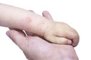Eczema em crianças: loções, cremes e emolientes podem ajudar a prevenir a condição