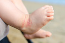 Eczema em crianças: loções, cremes e emolientes podem ajudar a prevenir a condição