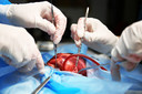 Ensaio afirma segurança de transplantes cardíacos de doadores com morte circulatória