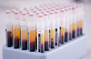 Exame de sangue se mostra promissor para detectar cânceres de alta mortalidade mais cedo