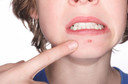 Excesso de peso aumenta risco de acne em adolescentes, publicado pelo Archives of Dermatology