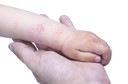 Maior gravidade da dermatite atópica está associada a dificuldades de aprendizagem em crianças