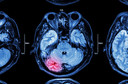 Medicamentos inibidores do SRAA para hipertensão podem proteger contra rupturas de aneurismas cerebrais