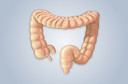 Mongersen, medicamento oral para a Doença de Crohn, teve os resultados preliminares publicados pelo NEJM