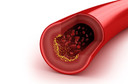 Níveis muito altos de colesterol HDL foram associados à morte precoce em pessoas com doença arterial coronariana