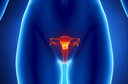 Rastreamento do câncer de ovário, utilizando o Risk of Ovarian Cancer Algorithm (ROCA), identificou tumores incidentes em fase inicial e demonstrou alto valor preditivo positivo