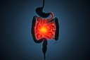 Risanquizumabe alivia a doença de Crohn moderada a grave