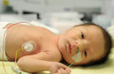 Suplemento de insulina no leite de bebês prematuros reforçou a alimentação