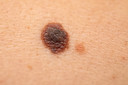Vírus do herpes que combate o câncer demonstra ser um tratamento eficaz para alguns tipos de melanoma avançado
