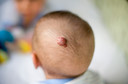 Pediatrics: retomada de crescimento de hemangioma infantil após terapia com propranolol